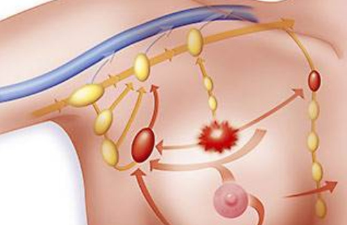 Staging & Sentinel Lymph Node Mapping