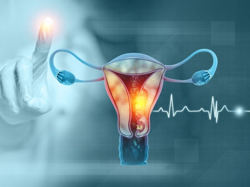 Endometrial Cancer